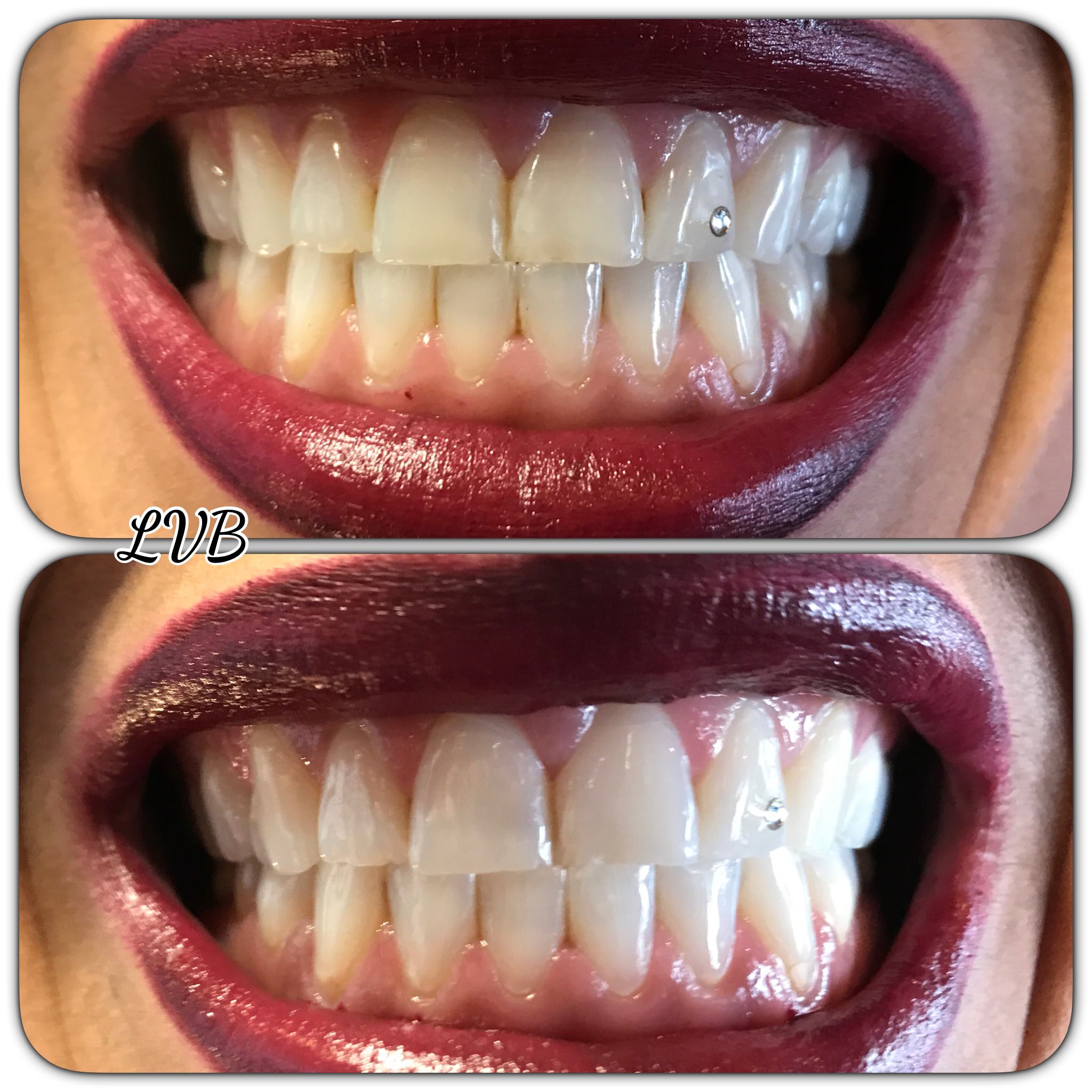 Blanchiment des dents avant/après