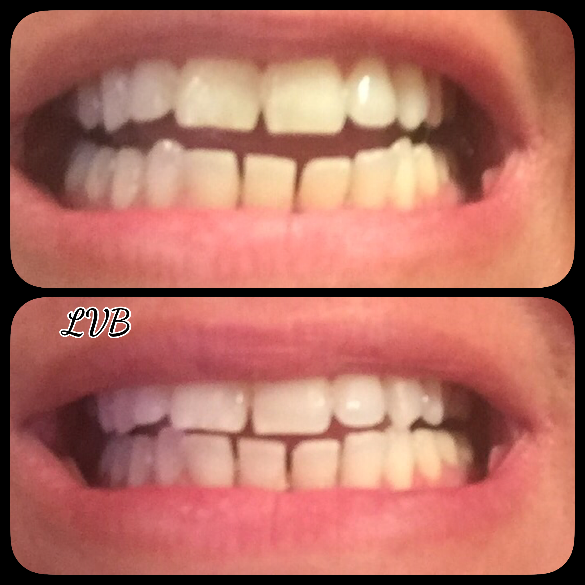 Blanchiment des dents avant/après